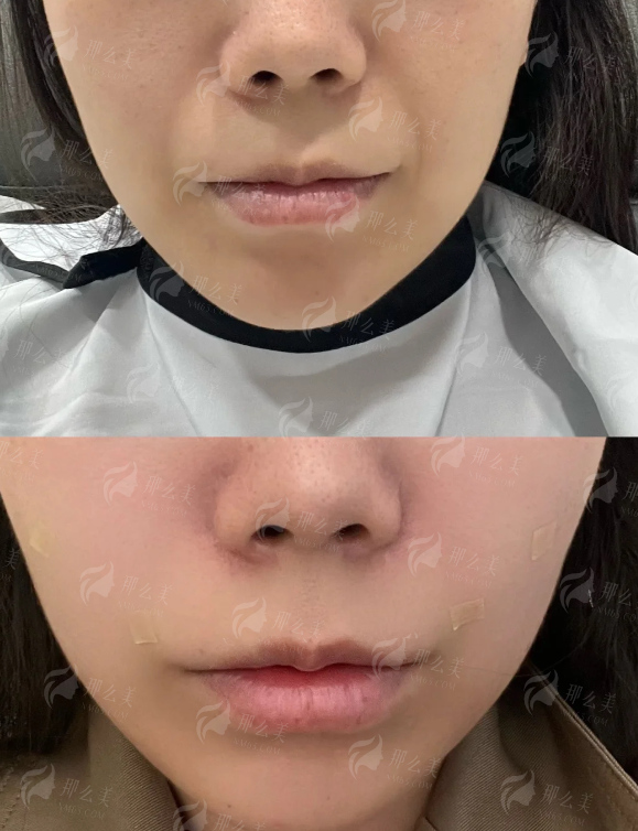 四、沈阳腾采医疗美容的孟强院长拉皮如何预约与选择？