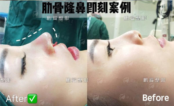 四、如何预约海口鹏爱医疗美容的超声炮及选择医生？