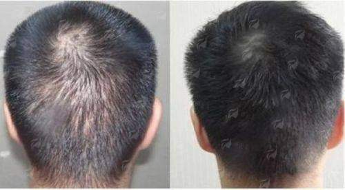 一、绍兴金柯桥医院植发科的发际线种植技术怎么样?
