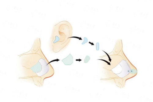 三、在秦皇岛念奴娇医疗美容做隆鼻有什么独特优势？