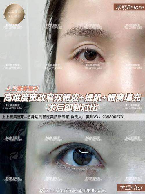 三、在丽水心艺医疗美容做双眼皮,价格、成效与安心如何保护?对比徐继强医生的风险有何优势?