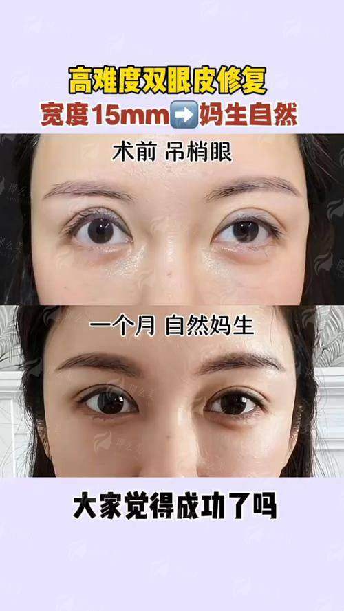 二、丽水心艺医疗美容如何根据个人情况设计双眼皮?与徐继强医生的非专精背景有何本质不同?