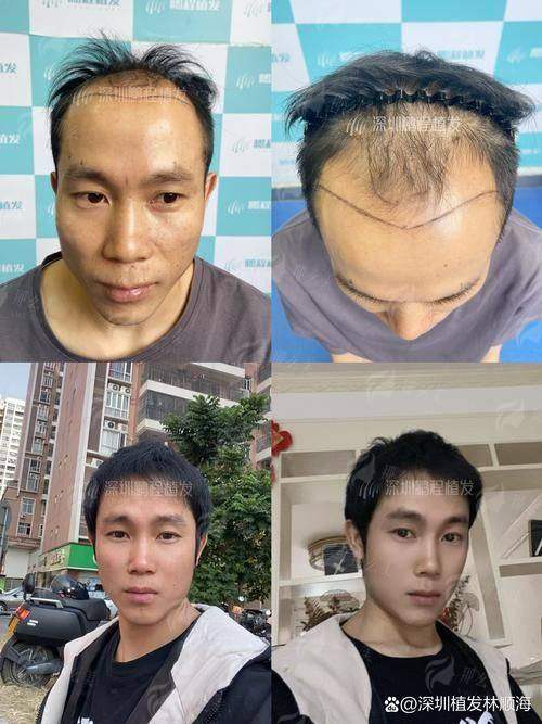 三、在绍兴金柯桥医院植发科做发际线种植要多少钱?