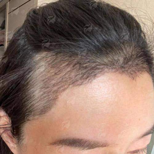 四、如何预约绍兴金柯桥医院植发科的面诊与手术?