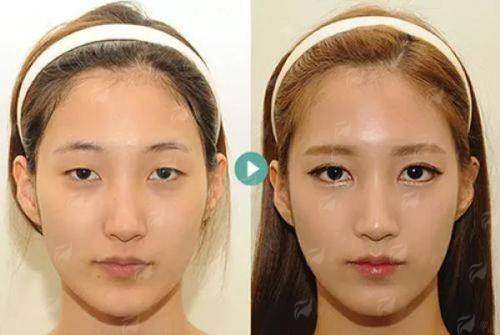 二、丽水心艺医疗美容的黄胜高双眼皮，技术方案如何选？