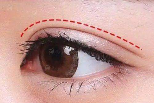 四、丽水心艺医疗美容的黄胜高双眼皮，如何预约与面诊？