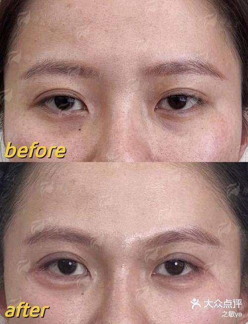 三、在益阳明瑞医疗美容做泪沟填充，价格与流程是怎样的？