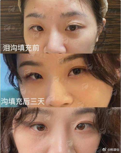 二、益阳明瑞医疗美容的泪沟填充技术有何特色？