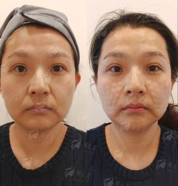 四、关于益阳明瑞提眉项目的价格、预约与常见问题全解析