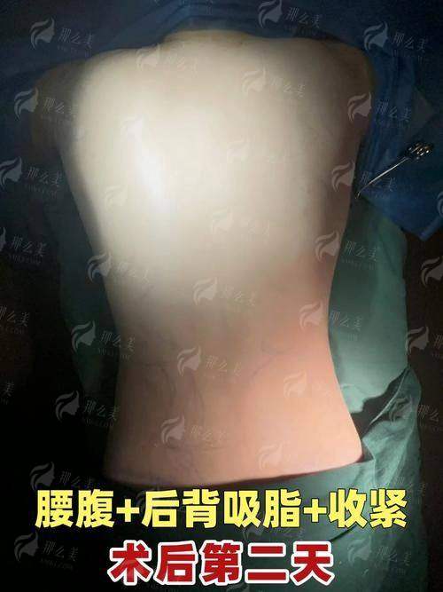 一、手臂吸脂手术有哪几种方式？廊坊医大（知颜）医疗美容详解