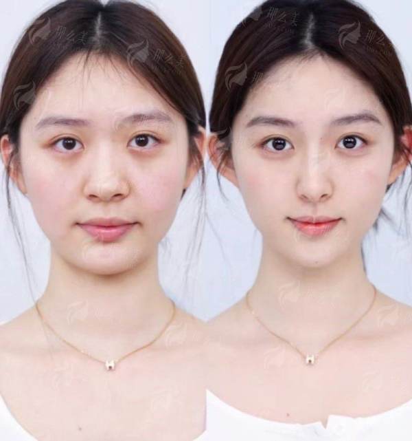 二、找北京雅宸医疗美容刘国东医生做双眼皮，价格和服务流程是怎样的？