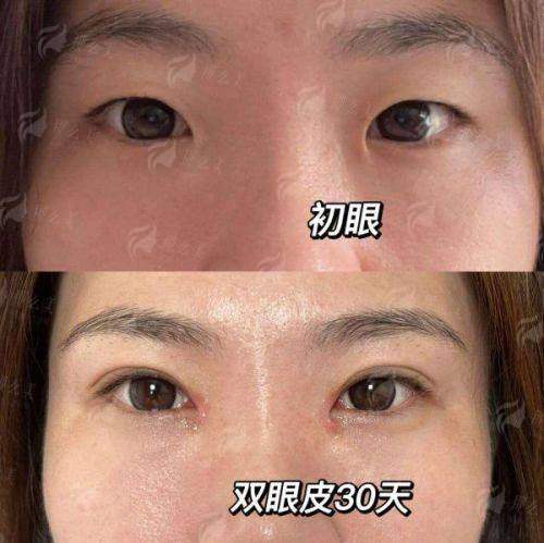 四、如何预约丽江悦莱美医疗的双眼皮整形面诊?