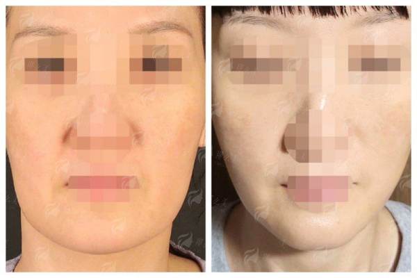 一、郑州东方整形贺焕焕医生的面部拉皮技术有何独到之处?