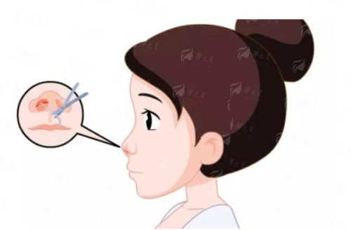 张平医生假体隆鼻做的怎么样？重庆万州华美紫馨真实案例推荐与预约方式