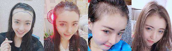 新颜智尚小程序一键预约！合肥曙光植发医院地址在哪？微针植发价格表及真实案例解析