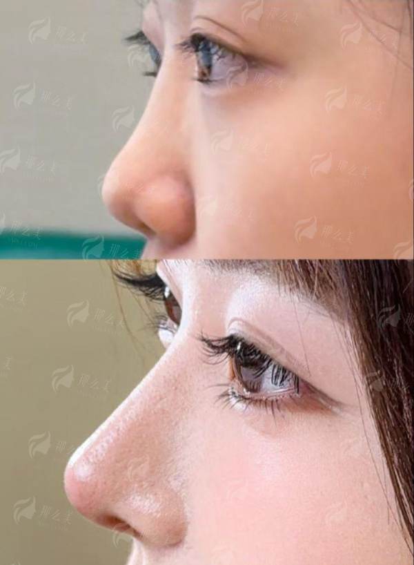 三、重庆万州华美紫馨整形医院的张平医生假体隆鼻如何预约与面诊?