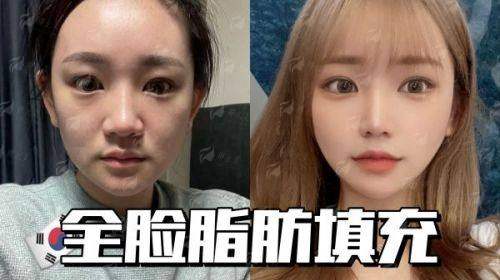 三、在哈尔滨超龙医疗美容医院做自体脂肪填充,流程和术后要注意什么?