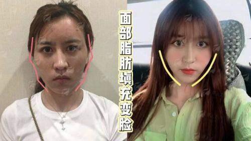 四、哈尔滨超龙医疗美容医院的自体脂肪填充,该如何预约与询问?