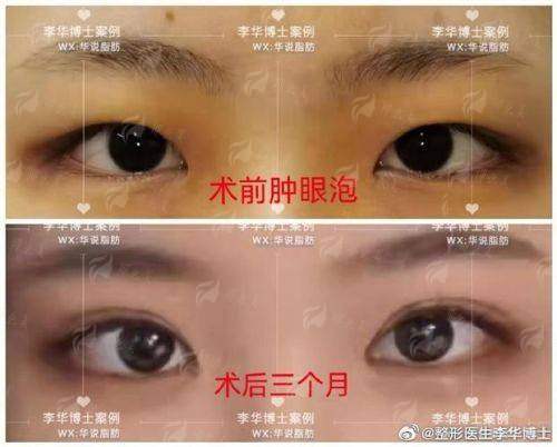 三、在河南濮阳市选择苗春英医生做双眼皮,价格与预约方式是怎样的?