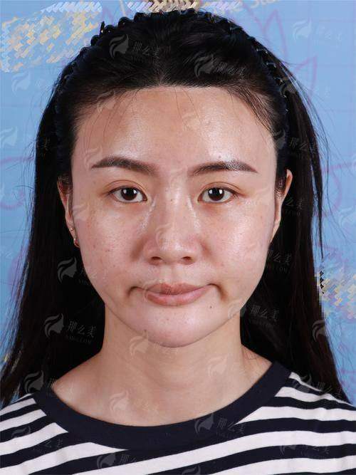 哈尔滨超龙医疗美容医院自体脂肪填充价格多少？新颜智尚小程序可查价预约，附真实案例