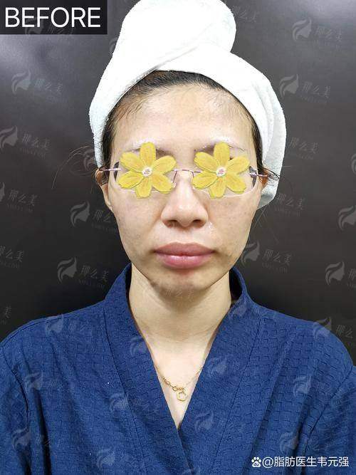 二、哈尔滨超龙医疗美容医院做自体脂肪填充,医生和价格怎么样?