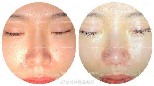 二、新疆奎屯优兰卡医美的鼻修复技术有哪些核心优势?