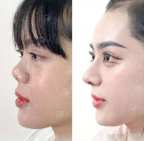 四、如何选择并成功预约新疆奎屯优兰卡医美的鼻修复服务?