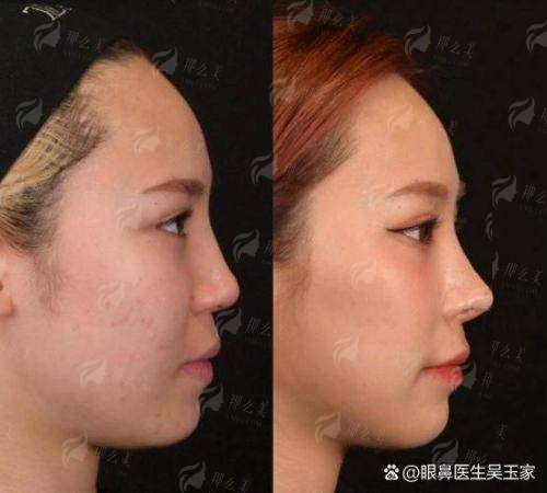 三、在新疆奎屯优兰卡医美进行鼻修复的流程与价格如何?