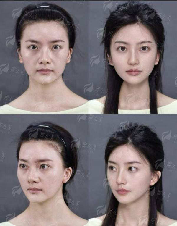 <strong>三、浙江金华丽都整形祛眼袋的价格与流程如何？</strong>