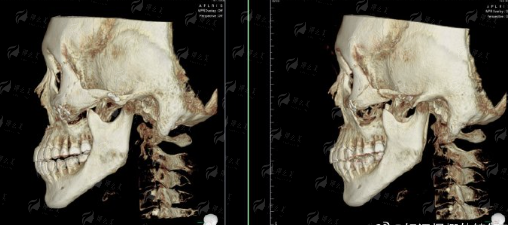 <strong>三、浙江金华丽都整形的提眉术如何选择与设计？</strong>