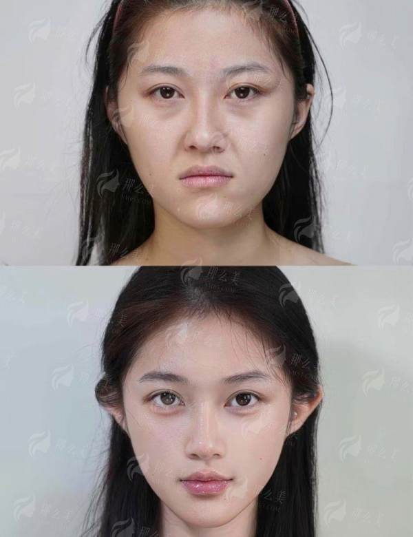 <strong>三、在河南新乡弈诺美医疗美容做祛眼袋要花多少钱？</strong>