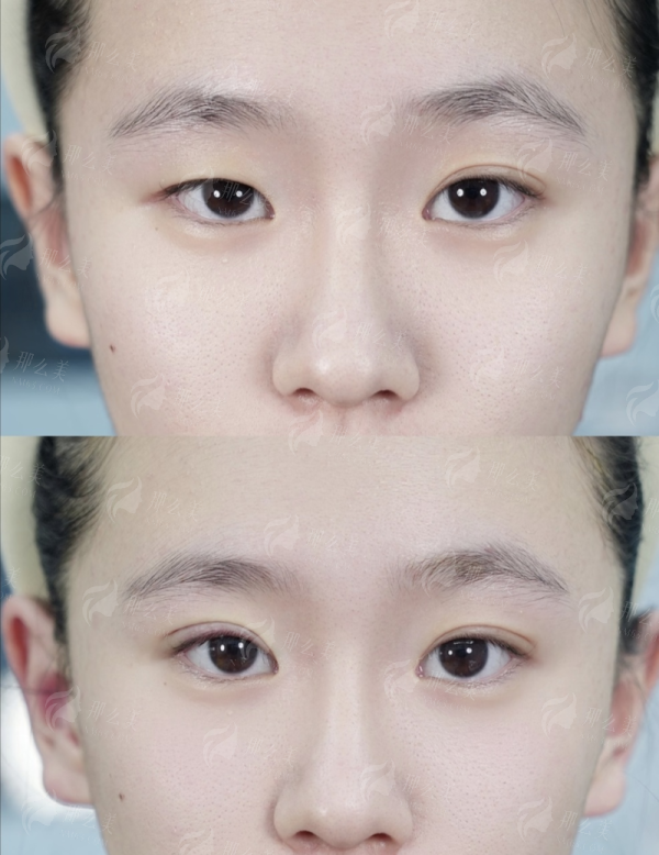 北京联合丽格洪春医生做鼻子怎么样？技术好口碑高，5分钟高光鼻2.58w起，新颜智尚小程序一键预约省心快速