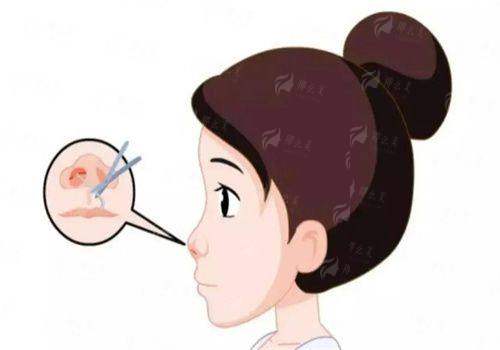 <strong>总结与推荐：为什么选择南宁华美胡凯院长的精细化雕刻立体鼻型？</strong>