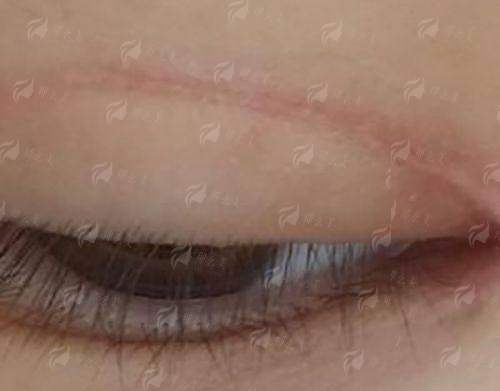 <strong>厦门华美假体隆胸项目价格与口碑参考</strong>