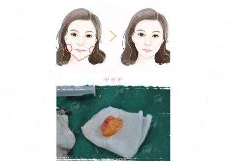 <strong>厦门华美俞积贵医生假体隆胸怎么约更快？两大核心策略</strong>