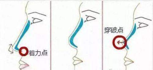 <strong style="color: rgb(255, 0, 0);">西宁韩美美容医院脂肪填充价格透明吗？2026年收费区间一览</strong>