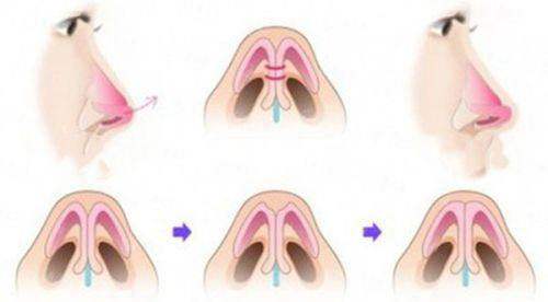 <strong>精细化雕刻立体鼻型综合整形：2026年价格区间与收费解析</strong>