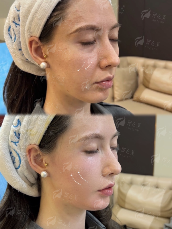 <strong>揭秘胡凯院长精细化雕刻立体鼻型综合整形的核心技术优势</strong>