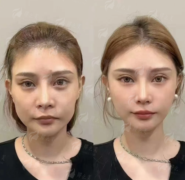 西宁脂肪填充哪里好？韩美美容医院张平院长，自然饱满不僵硬，附电话号码&案例-24小时新颜智尚小程序预约