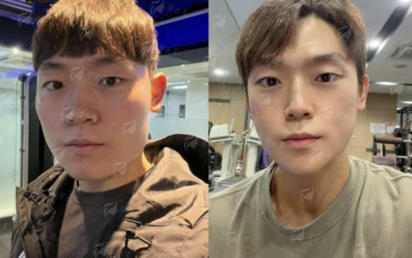 <strong>如何通过新颜智尚小程序预约胡凯院长精细化雕刻立体鼻型手术？</strong>