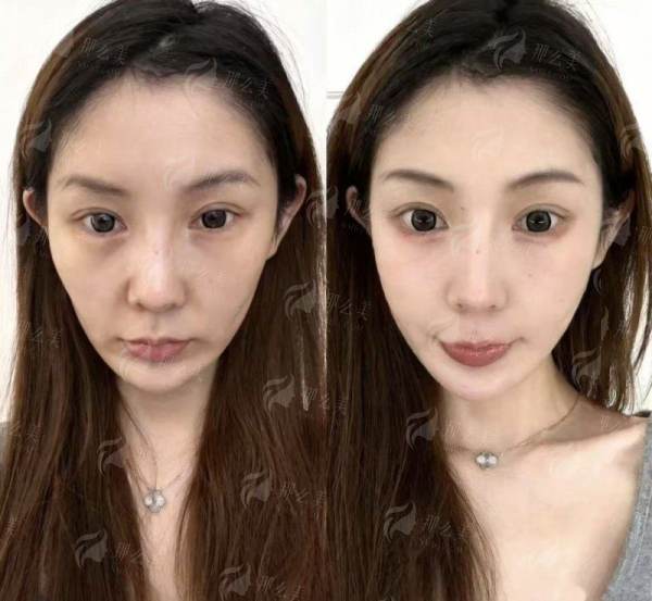 <strong>一篇讲透：高建朋医生具体擅长哪些热门医美项目？</strong>