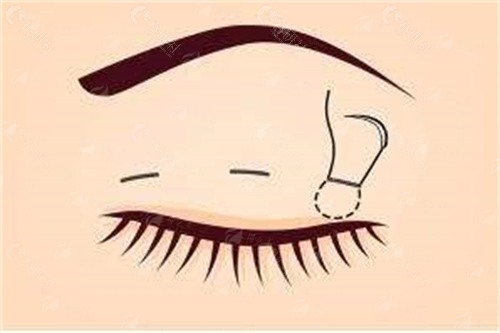 二、吴一医生颌面整形技术风格详解