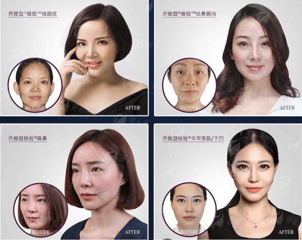 五、鼻中隔综合隆鼻价格及增值服务