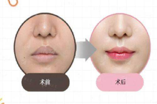 <strong>想找刘昭政隆鼻怎么预约更省心？揭秘特色治疗与仪器</strong>