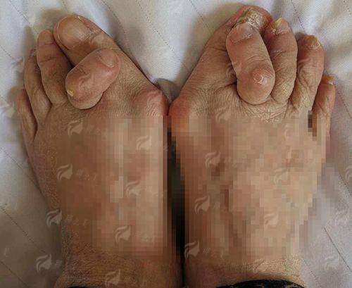 三、东莞美立方蜂巢皮秒真人成效反馈