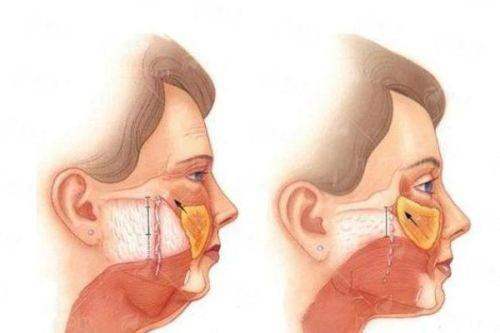 郑州张正文小耳症修复口碑如何？价格表&案例效果全解析，新颜智尚小程序一键预约！