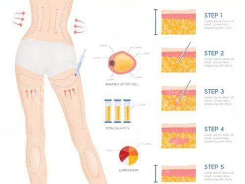 <strong>深度对比：王章霞医生的“微创”与“全切”双眼皮设计差异</strong>