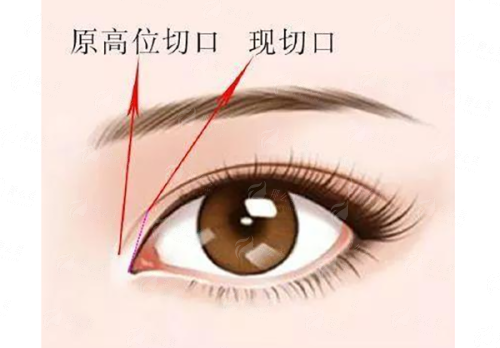 <strong>深度解析：美仑美奂董开云医生的眼部整形核心技术优势</strong>