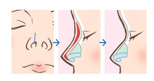 <strong>精灵耳做不好真的特别假！探访泉州亿星的品质服务与真实口碑</strong>