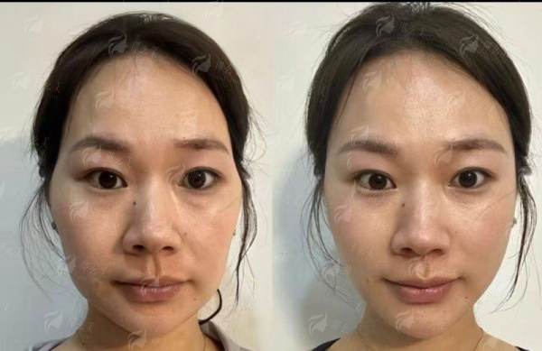 <strong>北京煤医西坝河眼鼻整形价格参考：2026年收费透明一览</strong>